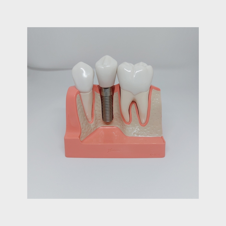 Maxi Implantat/Bro Studiemodel 